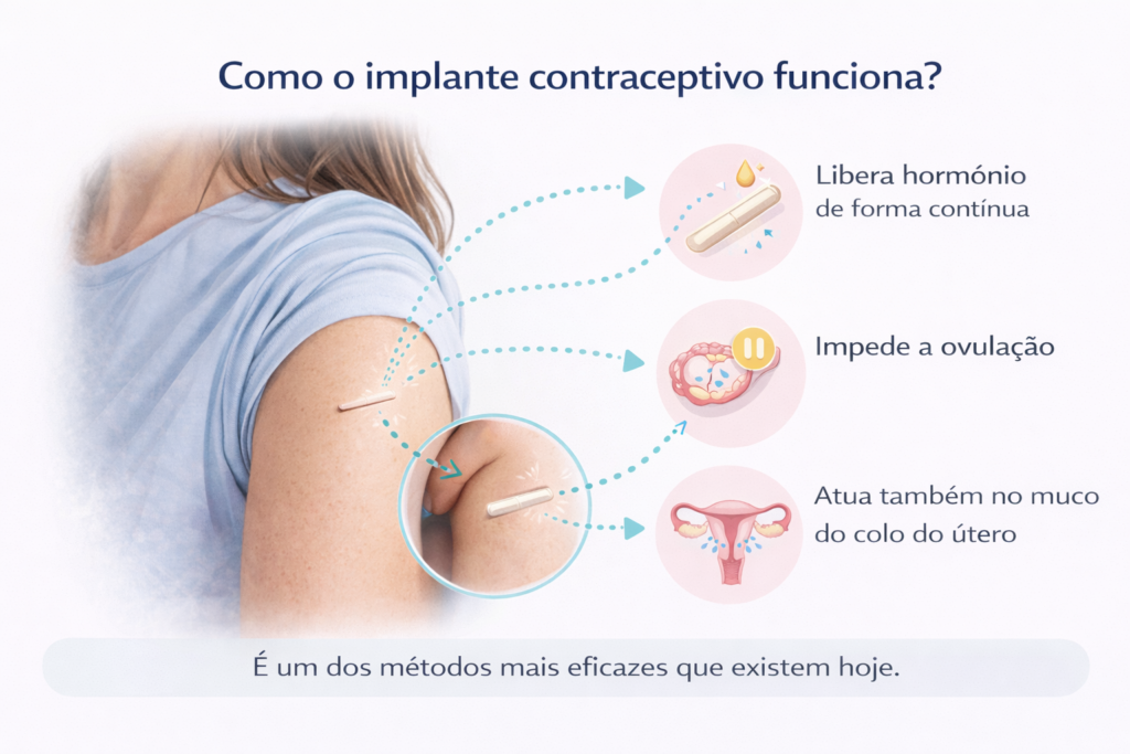 Ilustração explicando como o implante contraceptivo age no corpo feminino